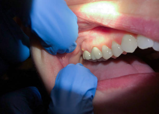 Best Emergency Treatment for Dental Infections or Abscesses in Westville, IN